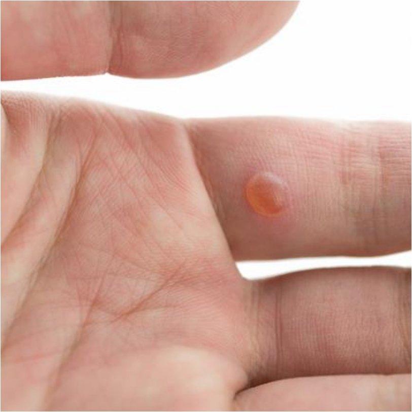 put a warm tea bag on the wart for 10 minutes per day, a few times per day. The wart should shrink after a couple of days.