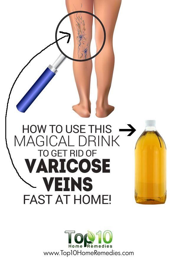 Remove Varicose Veins