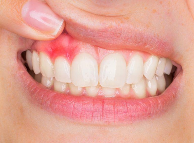 How To Fix Purple Gums