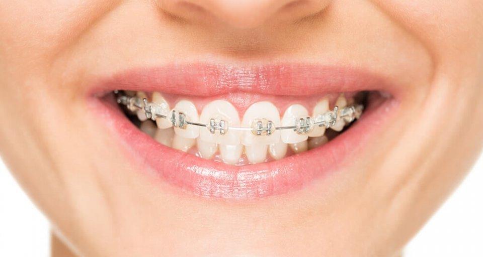 How To Alleviate The Discomfort Caused By Dental Braces - Zamm