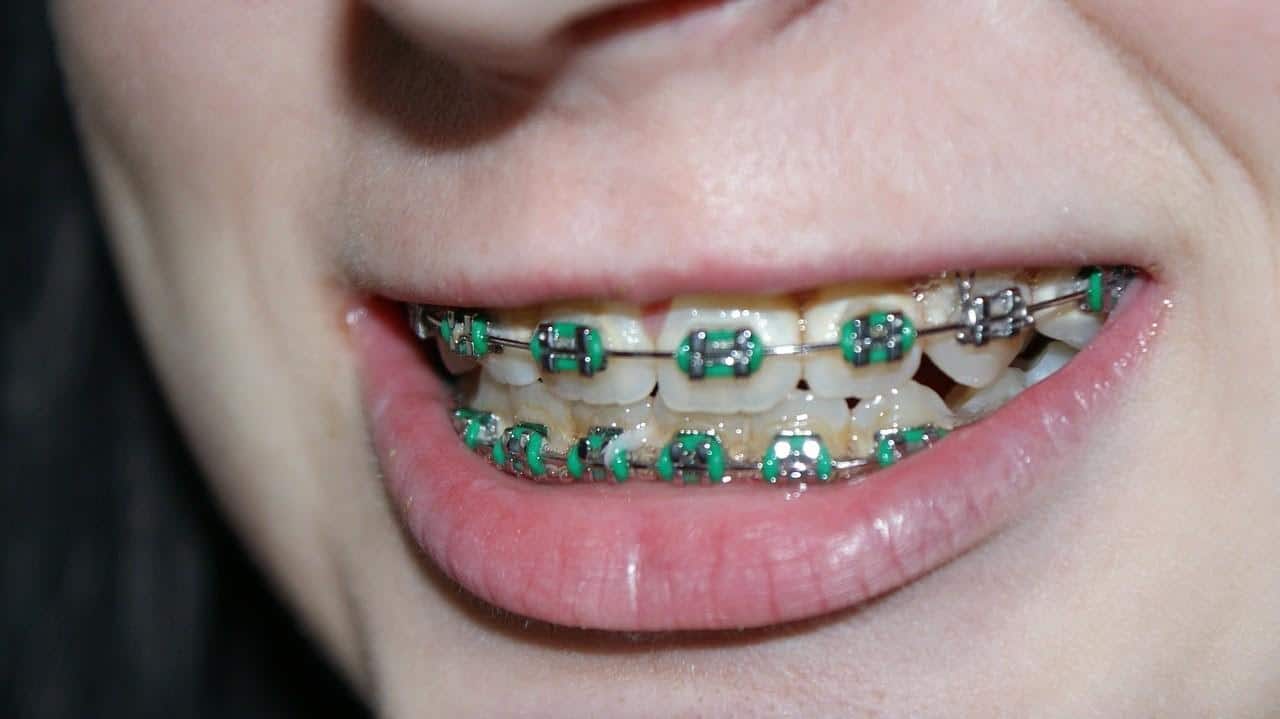 7 Things You Need to Know Before Getting Braces
