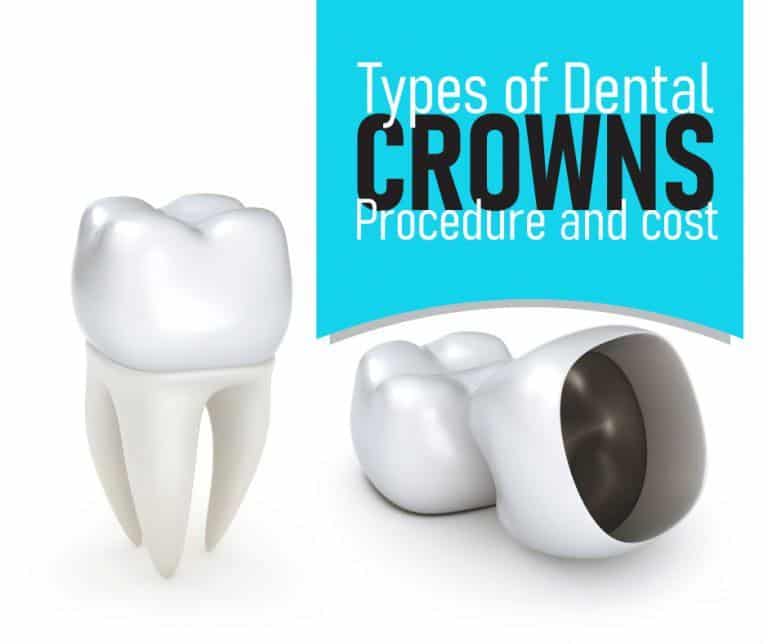 Types Of Dental Crowns: Procedure And Cost