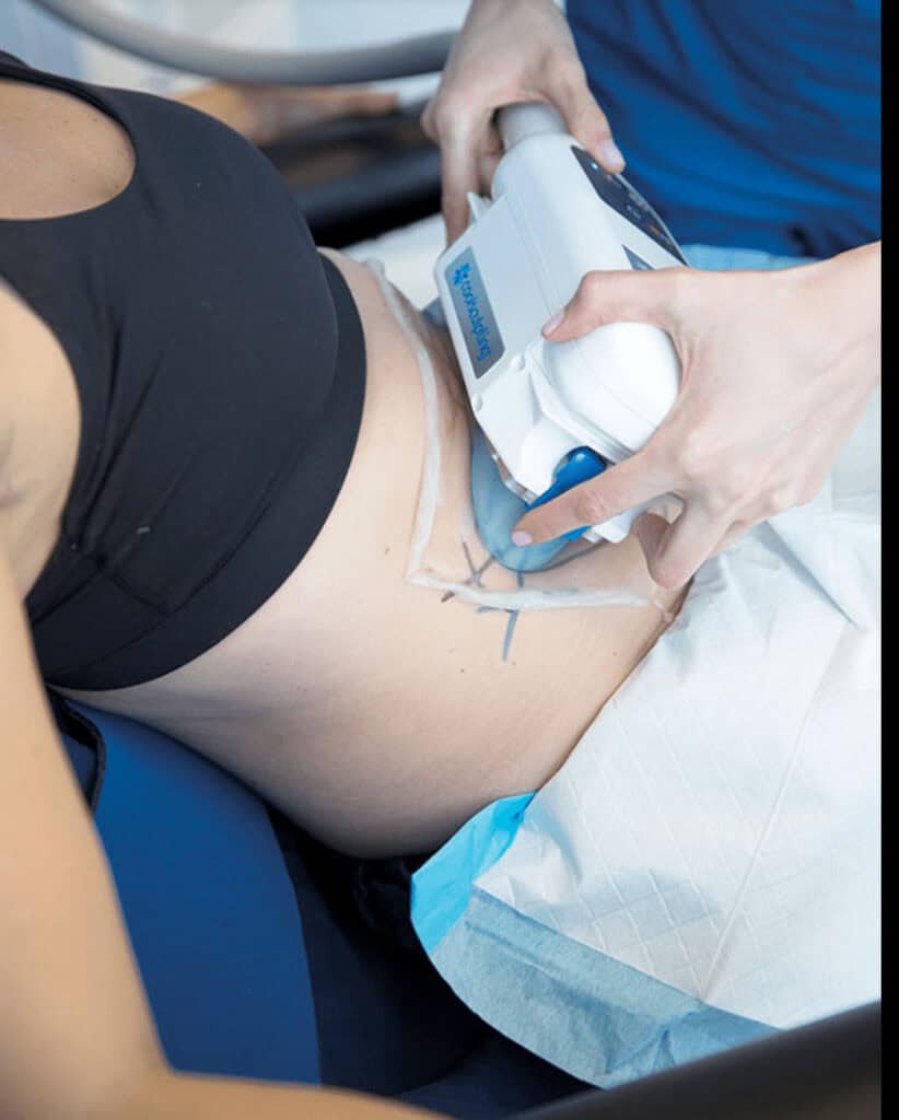 Coolsculpting