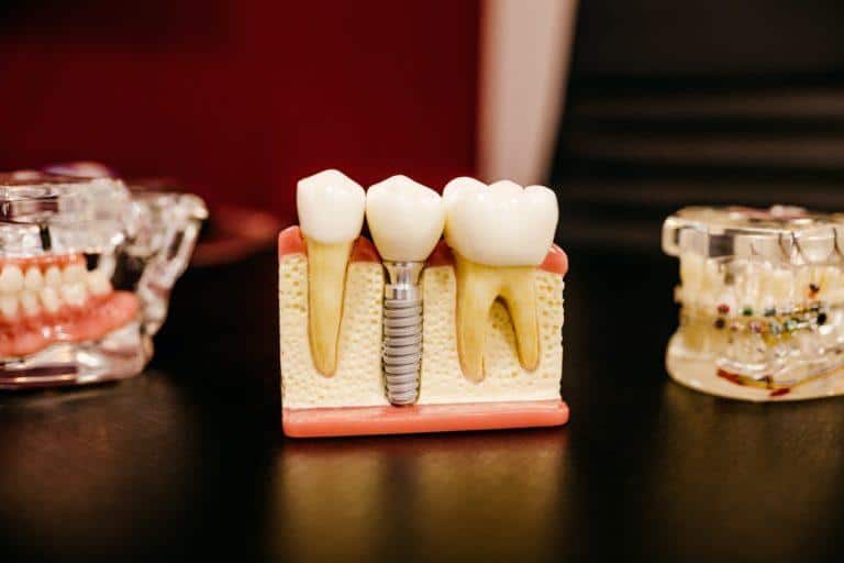 What You Need To Know About Dental Implants